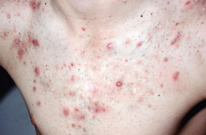 Fig. 4.8, Severe comedonal, inflammatory, and cystic acne on the chest.