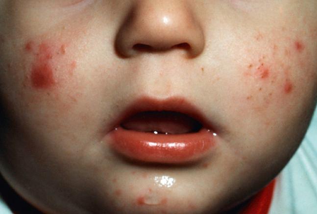 Fig. 4.9, Moderate comedonal and inflammatory infantile acne. Selectively treat acne prone sites to avoid irritation on normal skin.
