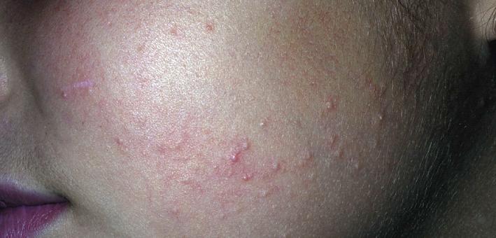 Fig. 4.10, Keratosis pilaris. Fine papules on an erythematous base are characteristic of keratosis pilaris that resembles acne.