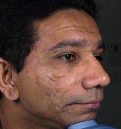 FIGURE 20.1, Pigmentation exaggerating the appearance of scarring.