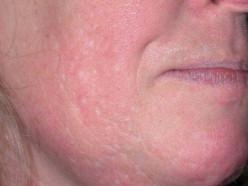 FIGURE 20.3, Hypopigmented acne scarring.