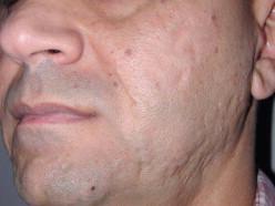 FIGURE 20.4, Scar appropriate for dermal augmentation.