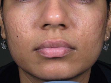 FIGURE 20.5, Grade II acne scarring.