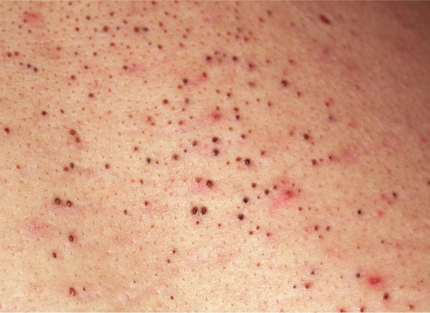 Fig. 21.1, Numerous microcomedones and comedones in patient with acne.