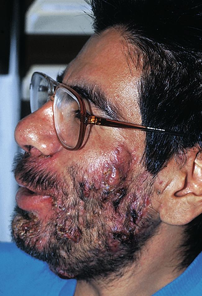 Fig. 21.2, Severe inflammatory cystic acne vulgaris.