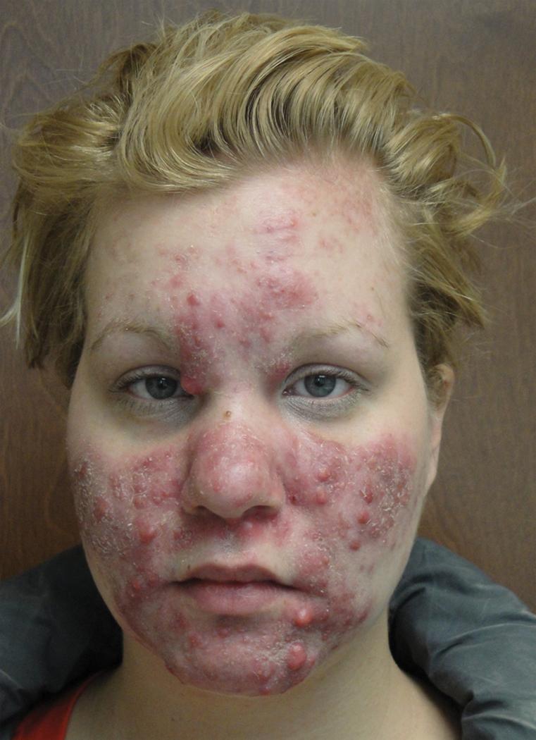 Fig. 9.1, Cystic Acne (Acne Conglobata).