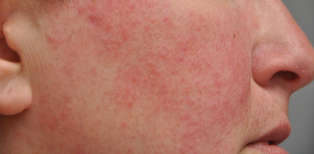 Fig. 9.2, Rosacea, Cheek.