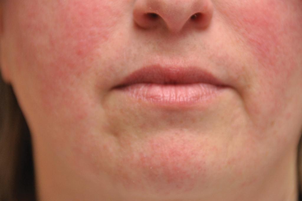 Fig. 9.3, Rosacea, Brow.