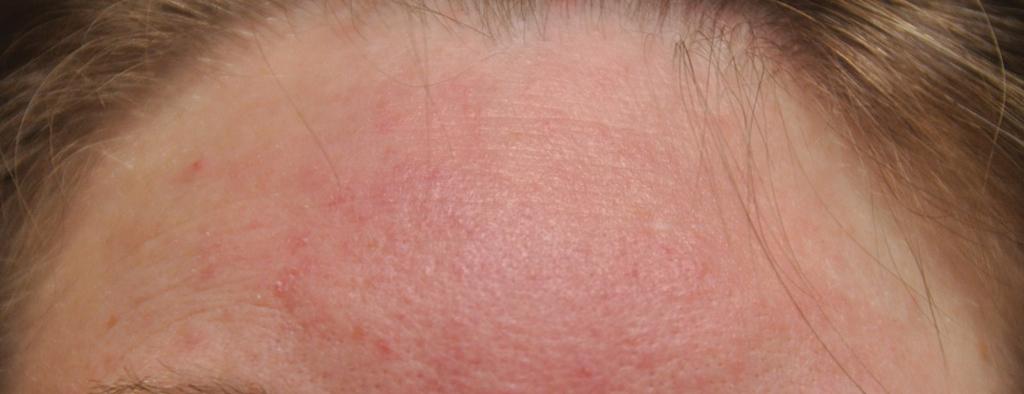 Fig. 9.4, Rosacea, Chin.