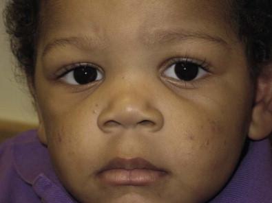 Figure 25.3, Infantile acne.