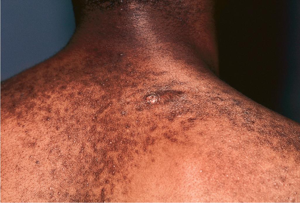 Fig. 8.11, Acne-induced dyspigmentation.