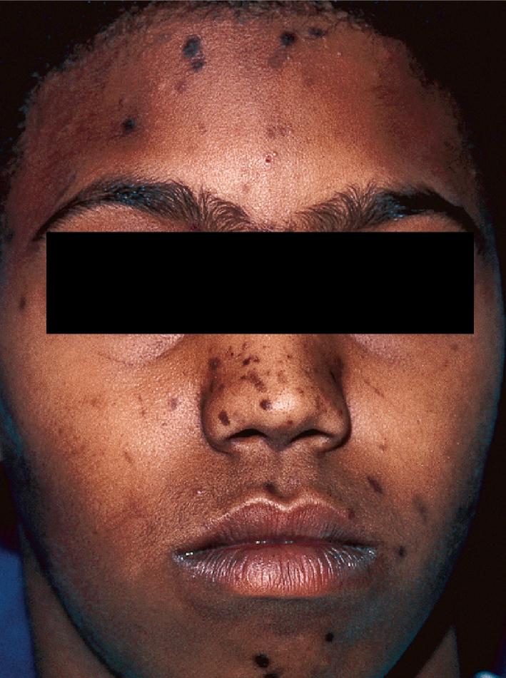 Fig. 8.12, Acne-induced dyspigmentation. Note the “T-zone” distribution corresponding to prior acne lesions.