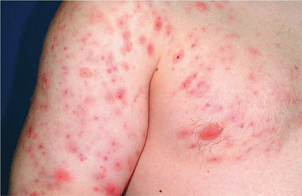 Fig. 8.13, Residual postacne erythema. Note erythematous macules at sites of prior lesions.