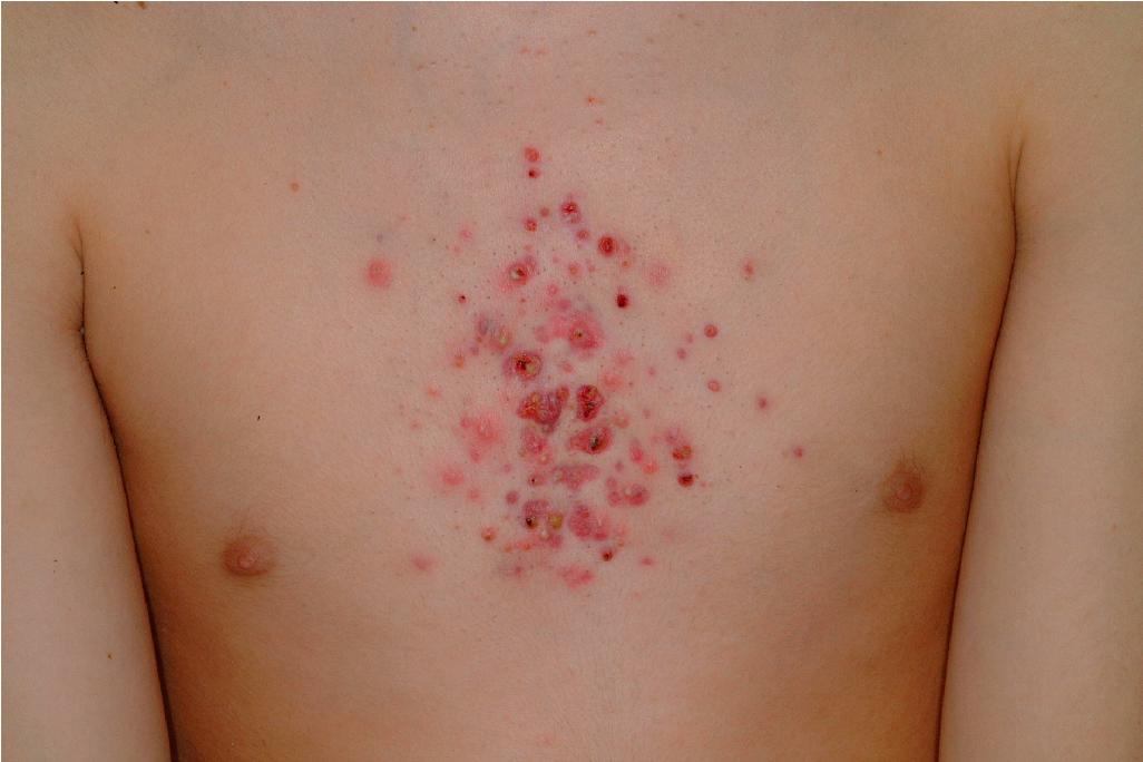 Fig. 8.14, Acne fulminans. This patient developed acute worsening of his acne lesions on starting isotretinoin therapy and required systemic corticosteroids.