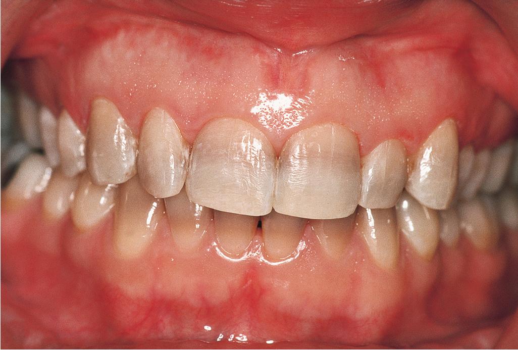 Fig. 8.15, Dental staining from tetracycline.