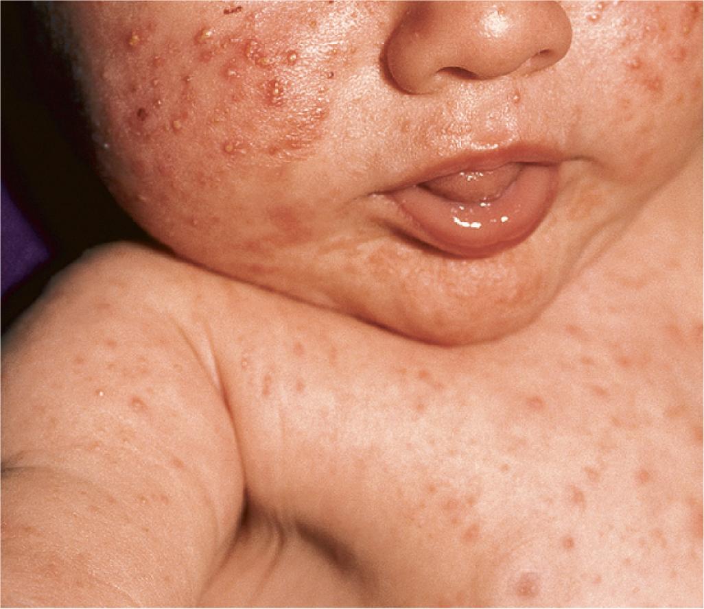 Fig. 8.17, Neonatal acne. This newborn had typical papules and pustules with rapid resolution over 1 month.