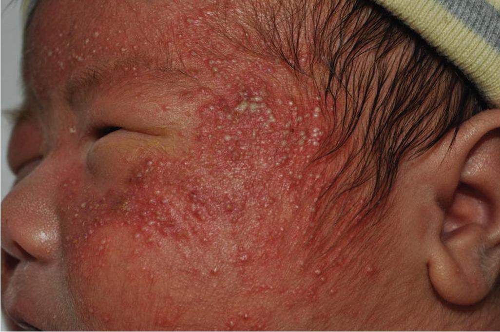 Fig. 8.18, Neonatal cephalic pustulosis. This 2-day-old male neonate (also shown in Fig. 2.16 ) presented with numerous inflammatory papules and pustules on the face; ketoconazole cream applied twice daily led to rapid resolution over 1 week.