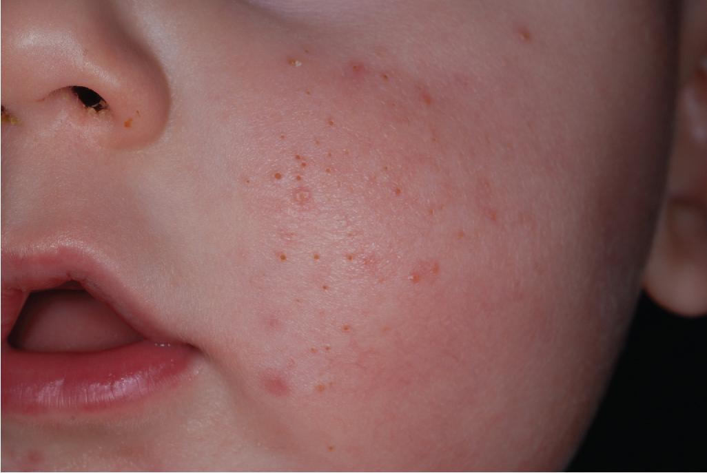 Fig. 8.19, Infantile acne. This child with infantile acne presented with primarily open and closed comedones.