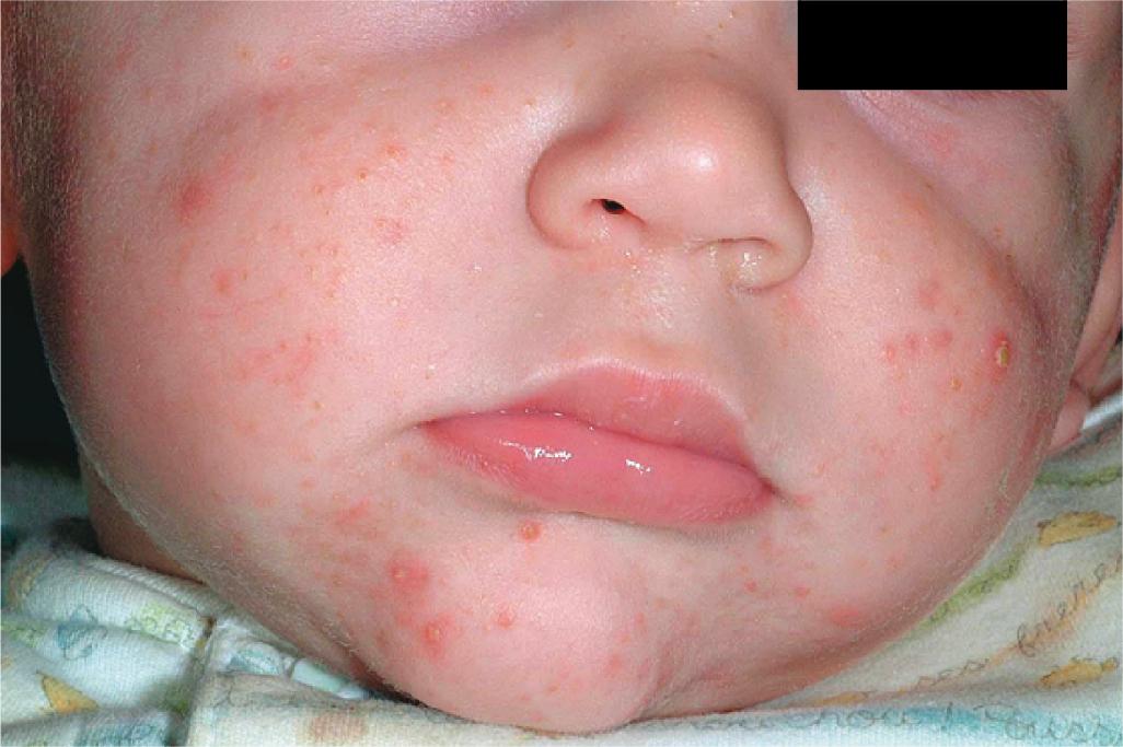 Fig. 8.20, Infantile acne. This infant had more persistent involvement with larger lesions such as the deep papulopustule on the left cheek.