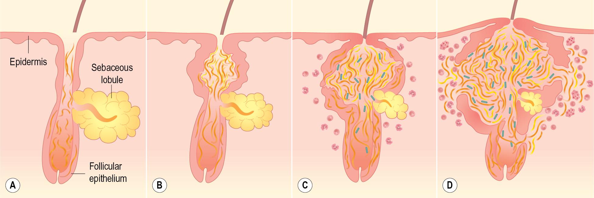 Fig. 8.2, Traditional view of acne pathogenesis. (A) Early comedone, with mild follicular plugging. (B) Later comedone. (C) Inflammatory papule/pustule. (D) Nodule/cyst. It should be noted that emerging studies suggest that subclinical inflammation may occur earlier in the pathogenesis, even before follicular plugging (A) .