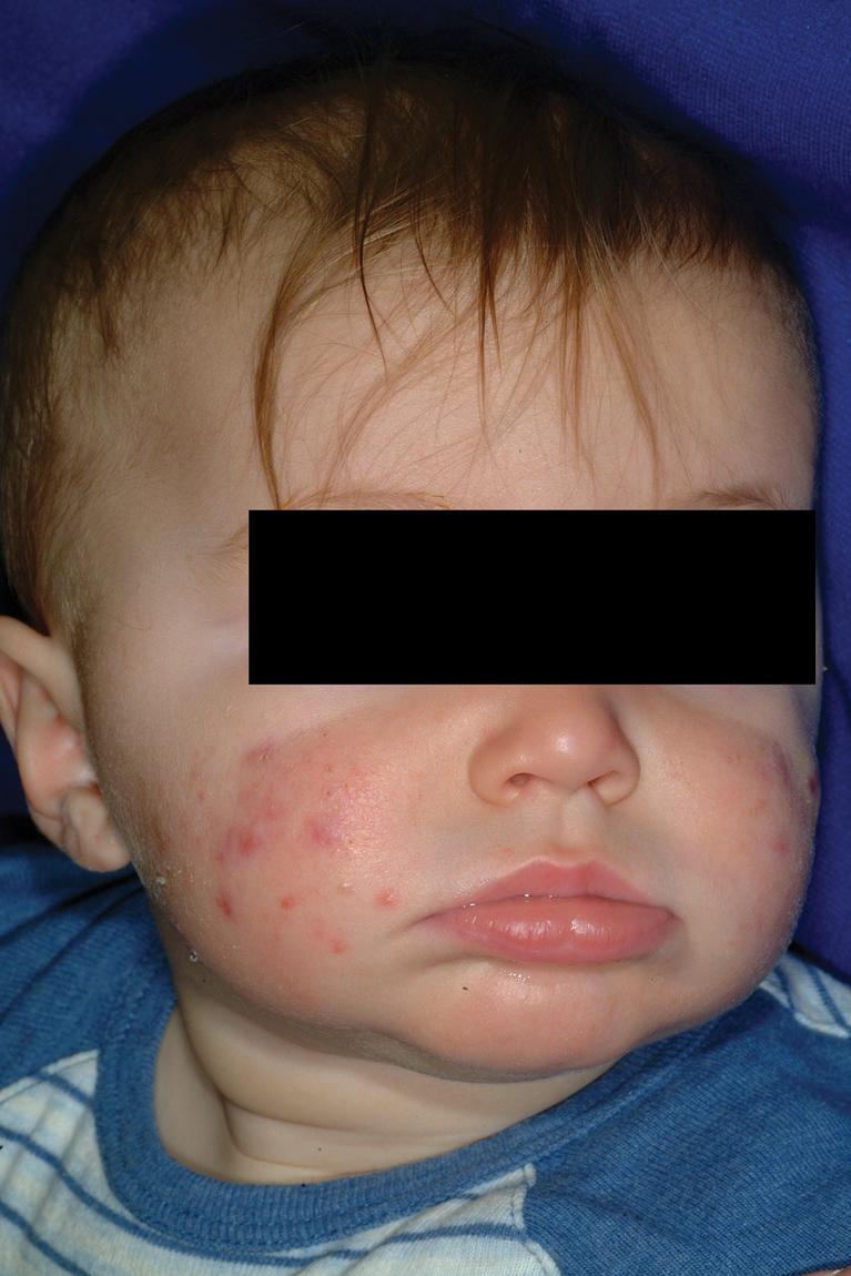 Fig. 8.21, Infantile acne. This infant had many inflammatory papules and nodules, which resulted in some permanent scarring.