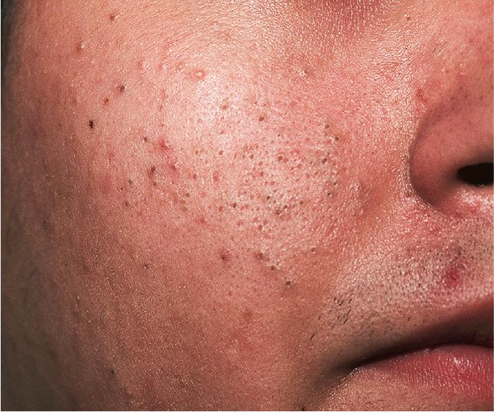 Fig. 8.3, Acne vulgaris: comedonal. Open comedones present as blackheads.