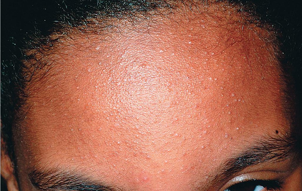 Fig. 8.4, Acne vulgaris: comedonal. Closed comedones present as whiteheads.