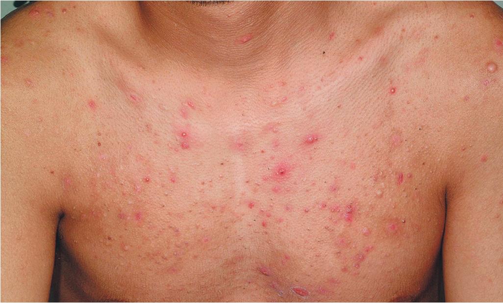 Fig. 8.5, Acne vulgaris: inflammatory. Note the erythematous papules and pustules, as well as open and closed comedones.