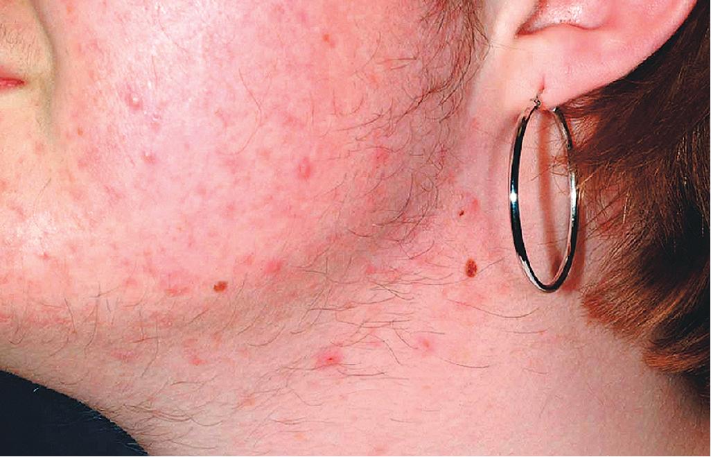 Fig. 8.6, Acne vulgaris: inflammatory. This adolescent girl has inflammatory papules and papulopustules, as well as hirsutism.