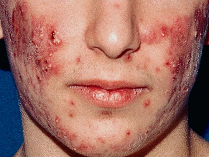 Fig. 8.7, Acne vulgaris: nodulocystic.