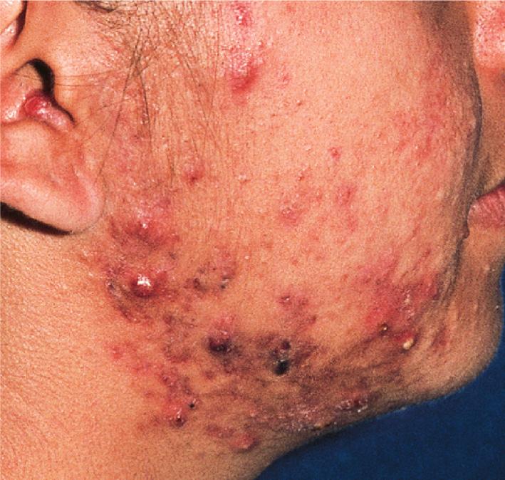 Fig. 8.8, Acne vulgaris: nodulocystic.