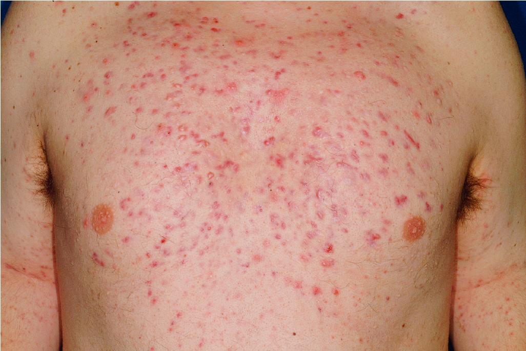 Fig. 8.9, Acne scarring. This patient has severe nodular acne vulgaris with scarring involving the trunk.