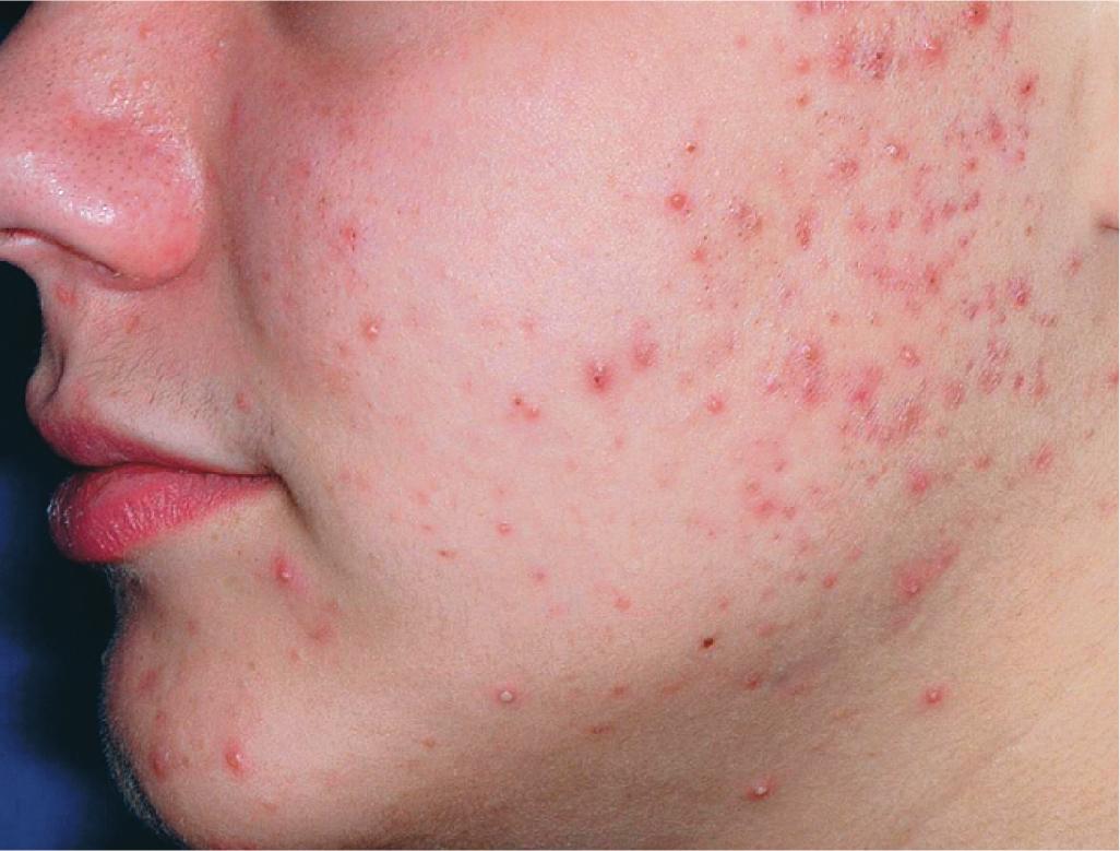 Fig. 8.10, Acne scarring.