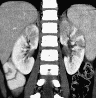 Figure 114.2, Multifocal bacterial pyelonephritis.