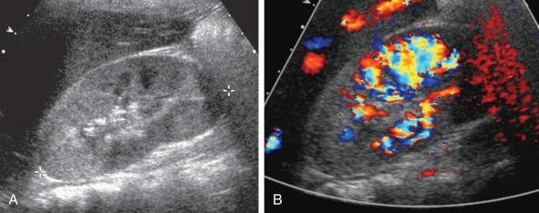 Figure 114.4, Acute bacterial pyelonephritis.