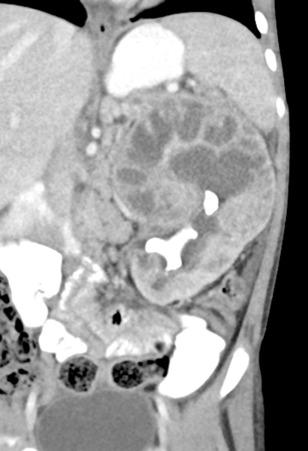 Figure 114.6, Xanthogranulomatous pyelonephritis.