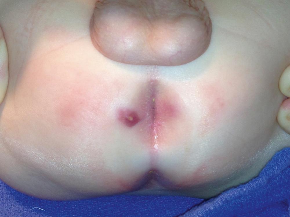 Fig. 37.1, Perianal abscesses are often seen in male infants. The abscess typically presents as a fluctuant, tender mass in the perianal region. Incision and drainage is the initial management of these abscesses if conservative measures have failed.