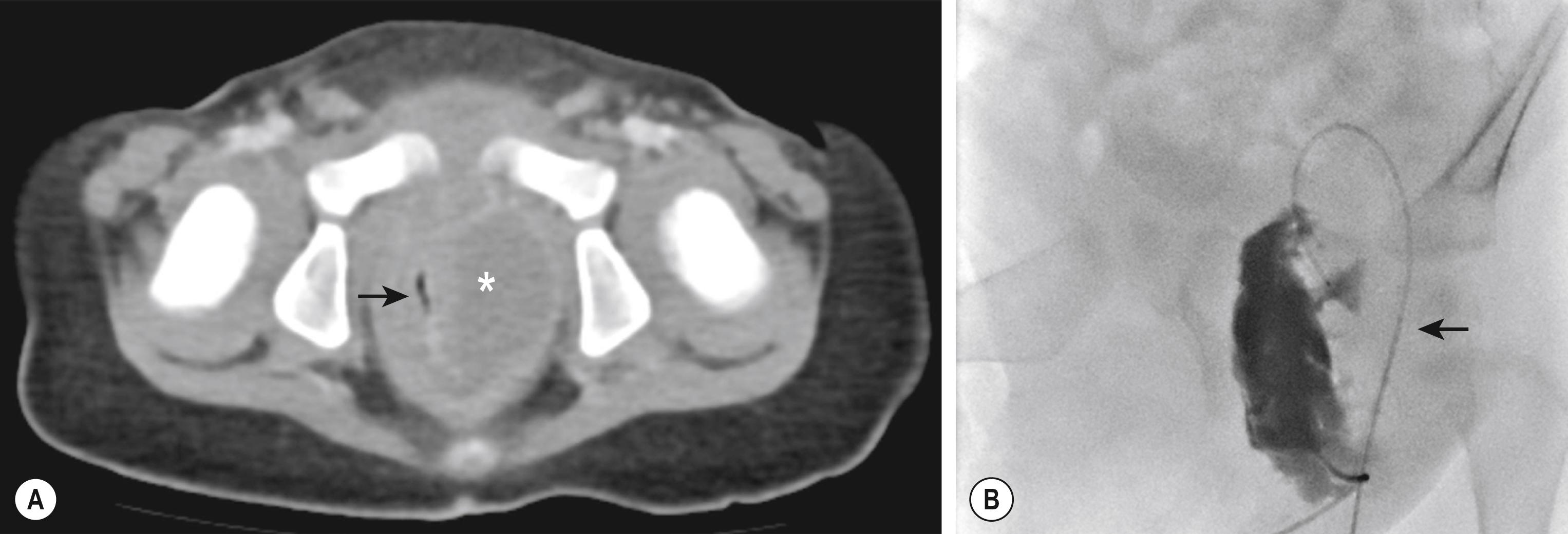 Fig. 37.2, (A) CT image of a complex ischiorectal abscess (asterisk) in an adolescent with Crohn disease. Note the rectum (arrow) is markedly compressed. (B) This contrast study identifies the large abscess cavity. A drain was positioned over the guide wire (arrow) and left in situ to drain the abscess cavity.