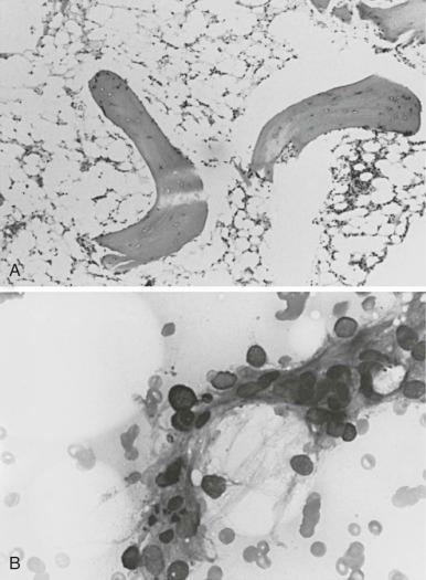 Figure 6-1, Bone marrow examination in severe aplastic anemia.