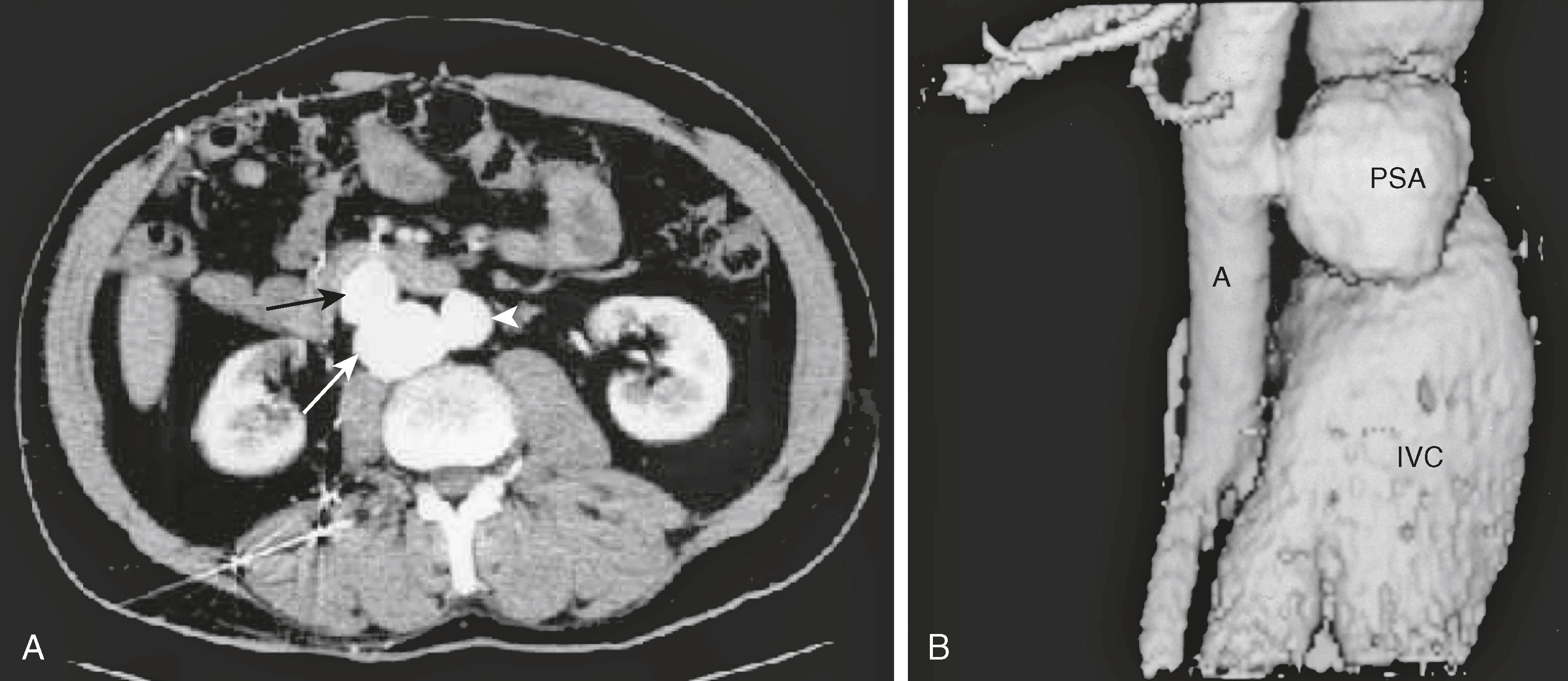 Figure 173.1, ( A ) Axial CT scan demonstrating the aorta (arrowhead) , pseudoaneurysm (white arrow) , and inferior vena cava (black arrow) . ( B ) Three-dimensional reconstruction of the CT scan of a traumatic aortocaval fistula demonstrating a pseudoaneurysm (PSA), enlarged inferior vena cava (IVC), and aorta (A) .