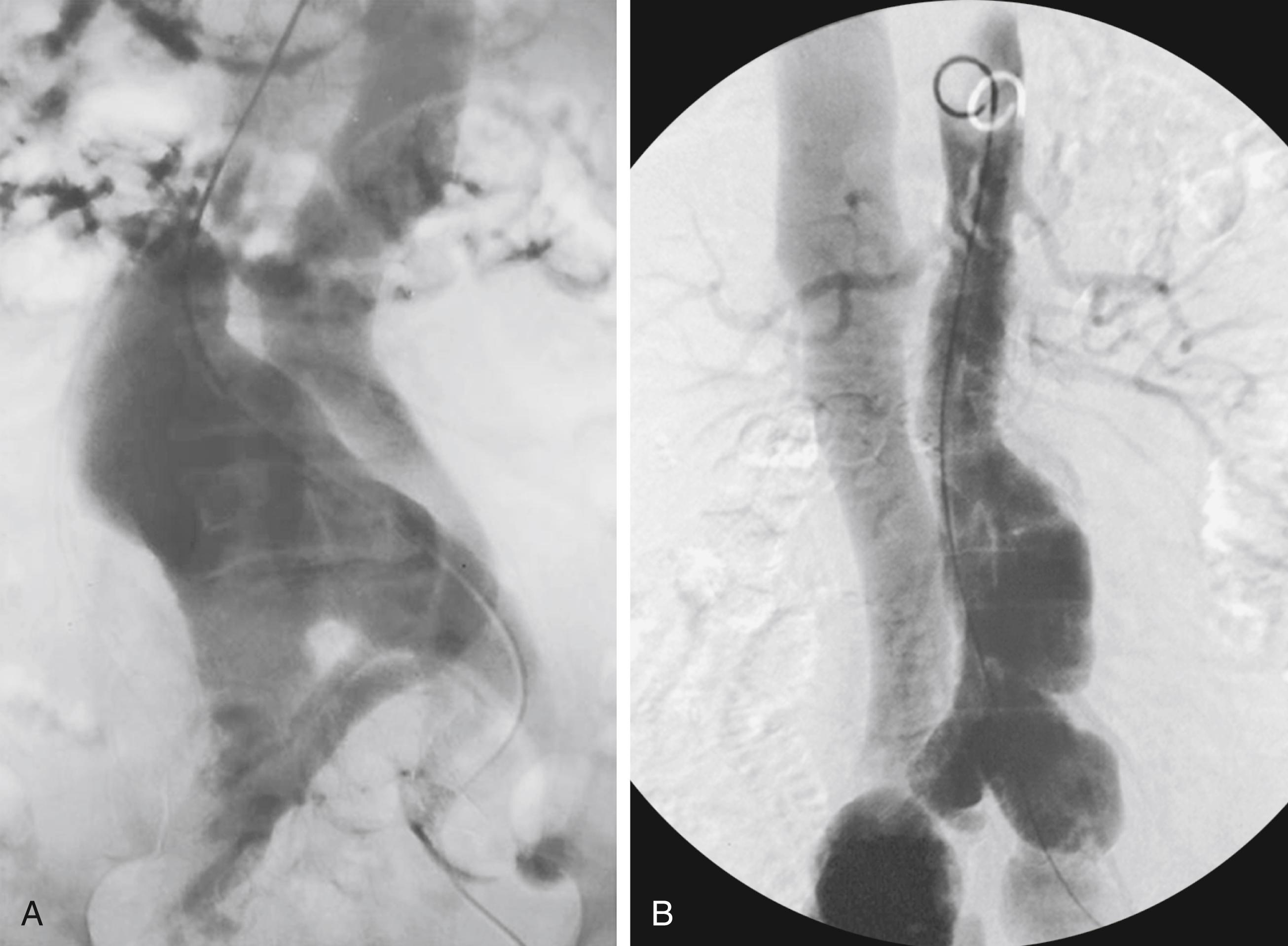 Figure 173.2, ( A ) Aortogram of a patient with an aortic aneurysm and spontaneous aortocaval fistula treated surgically. ( B ) Aortogram demonstrating an aortic aneurysm and bilateral iliac aneurysms associated with an arteriovenous fistula between the right common iliac artery and vein treated with an aortic endograft.