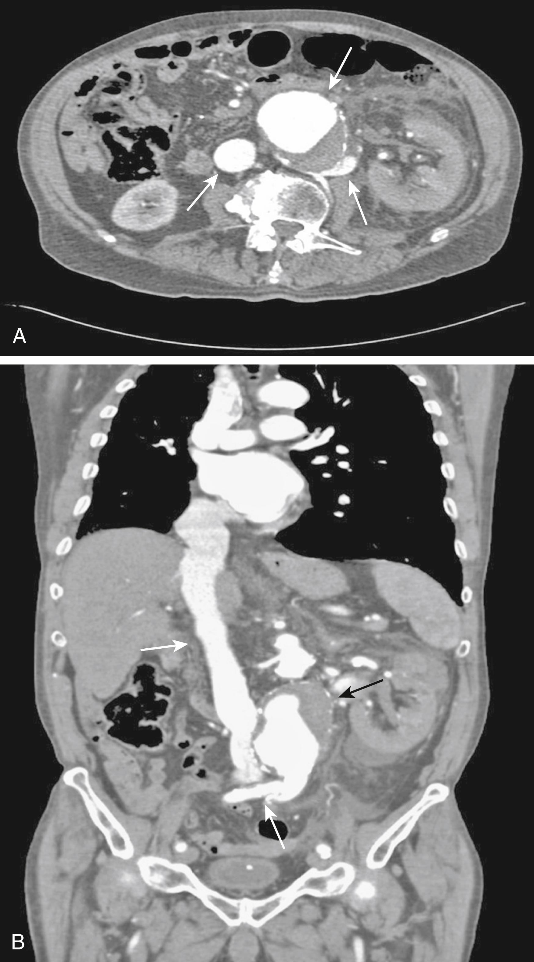 Figure 173.3, ( A ) Axial CT scan demonstrating an aortorenal arteriovenous fistula. Contrast material is present in the abdominal aortic aneurysm (top arrow) , inferior vena cava (left arrow) , and retro-aortic left renal and lumbar veins (right arrow) . ( B ) Sagittal reconstruction of the CT scan in ( A ) showing contrast material in the aneurysm (black arrow) , inferior vena cava (top white arrow) , and retro-aortic left renal and lumbar veins (bottom white arrow) .