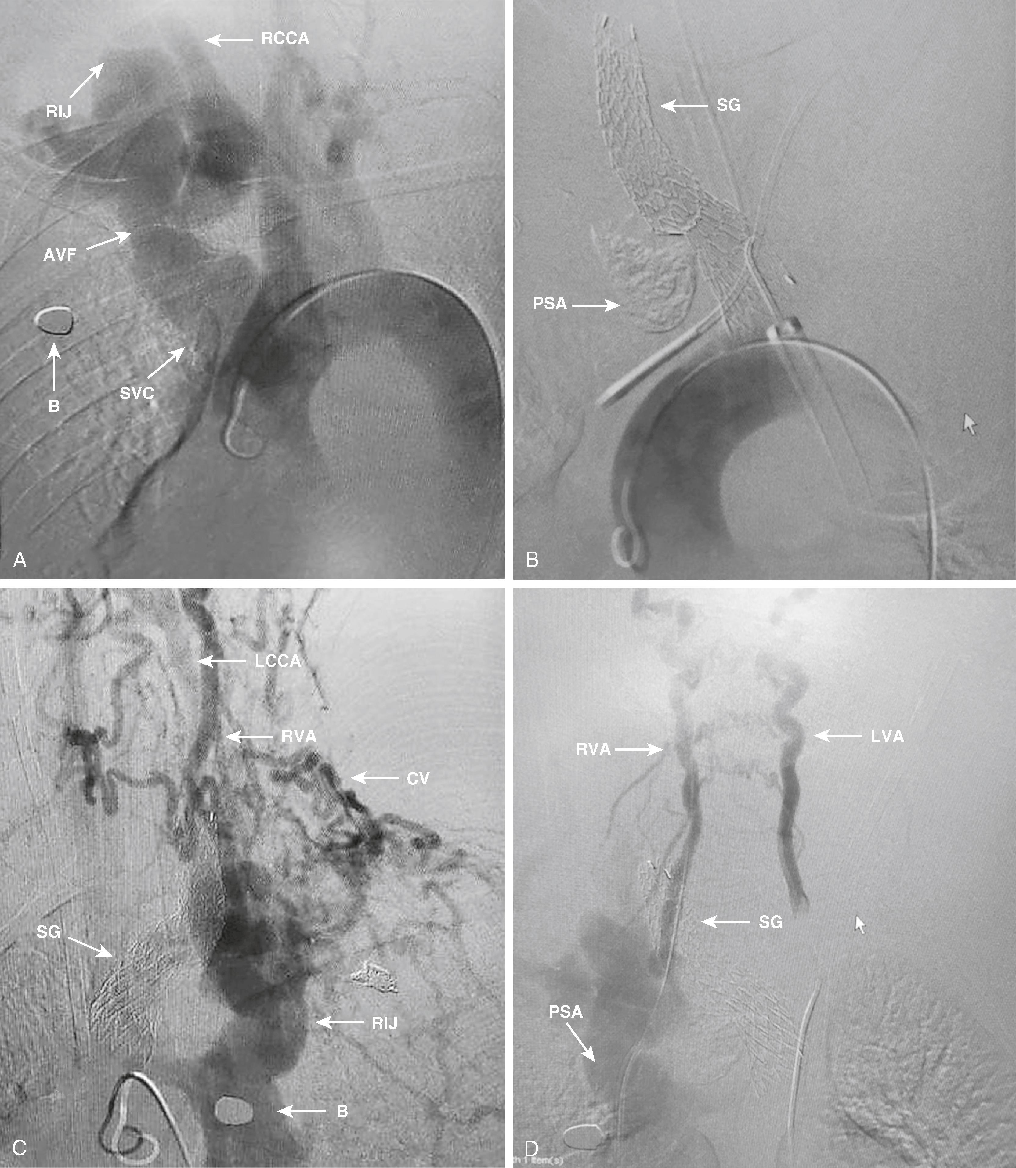 Figure 173.4, Arch aortogram showing ( A ) an innominate superior vena caval arteriovenous fistula (AVF), ( B ) stent graft (SG) and calcified pseudoaneurysm (PSA); ( C ) recurrence of the AVF due to ( D ) reversal of flow in the right vertebral artery. RIJ , right internal jugular vein; B , bullet fragment; SVC , superior vena cava; RCCA/LCCA , right/left common carotid artery; CV , collateral vessels; LVA , left vertebral artery.