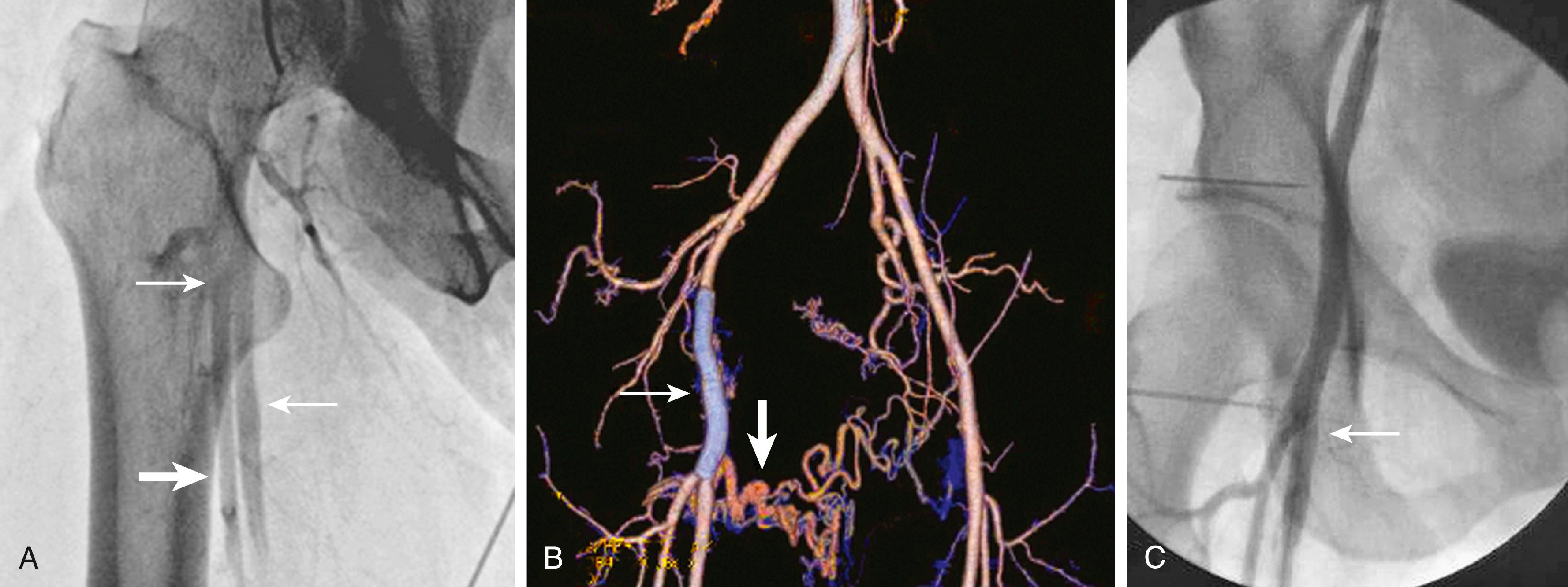 Figure 173.5, ( A ) Selective femoral angiogram demonstrating an arteriovenous fistula (AVF; upper arrow ) at the common femoral bifurcation, outlining the superficial femoral vein (middle arrow) and artery (lower arrow) . ( B ) CT reconstruction showing persistence of the AVF (vertical arrow) below a covered stent graft (horizontal arrow) used to treat common femoral stenosis after attempted operative repair of the fistula. ( C ) Selective femoral angiogram demonstrating closure of the fistula after placement of an additional covered stent graft (arrow) .