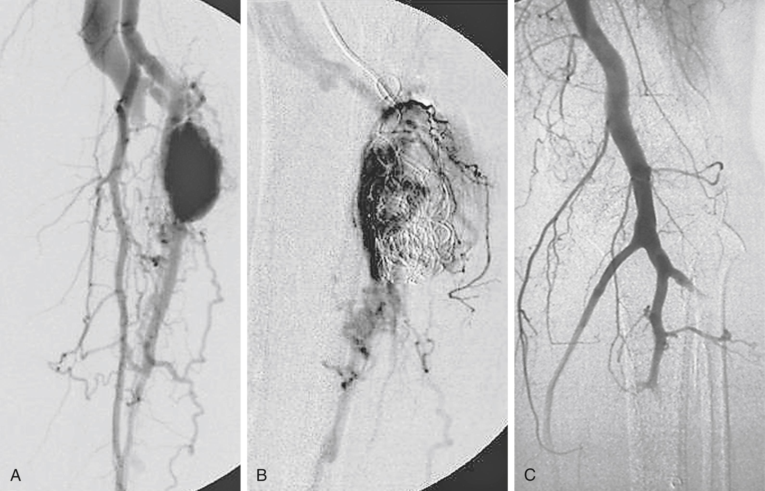 Figure 173.6, ( A ) Selective femoral angiogram demonstrating an arteriovenous fistula (AVF) between the anterior tibial artery and vein. ( B ) Coil embolization of the AVF. ( C ) Occlusion of the tibioperoneal trunk by a dislodged coil, resulting in severe limb ischemia requiring treatment with a popliteal-to-posterior tibial venous bypass graft.