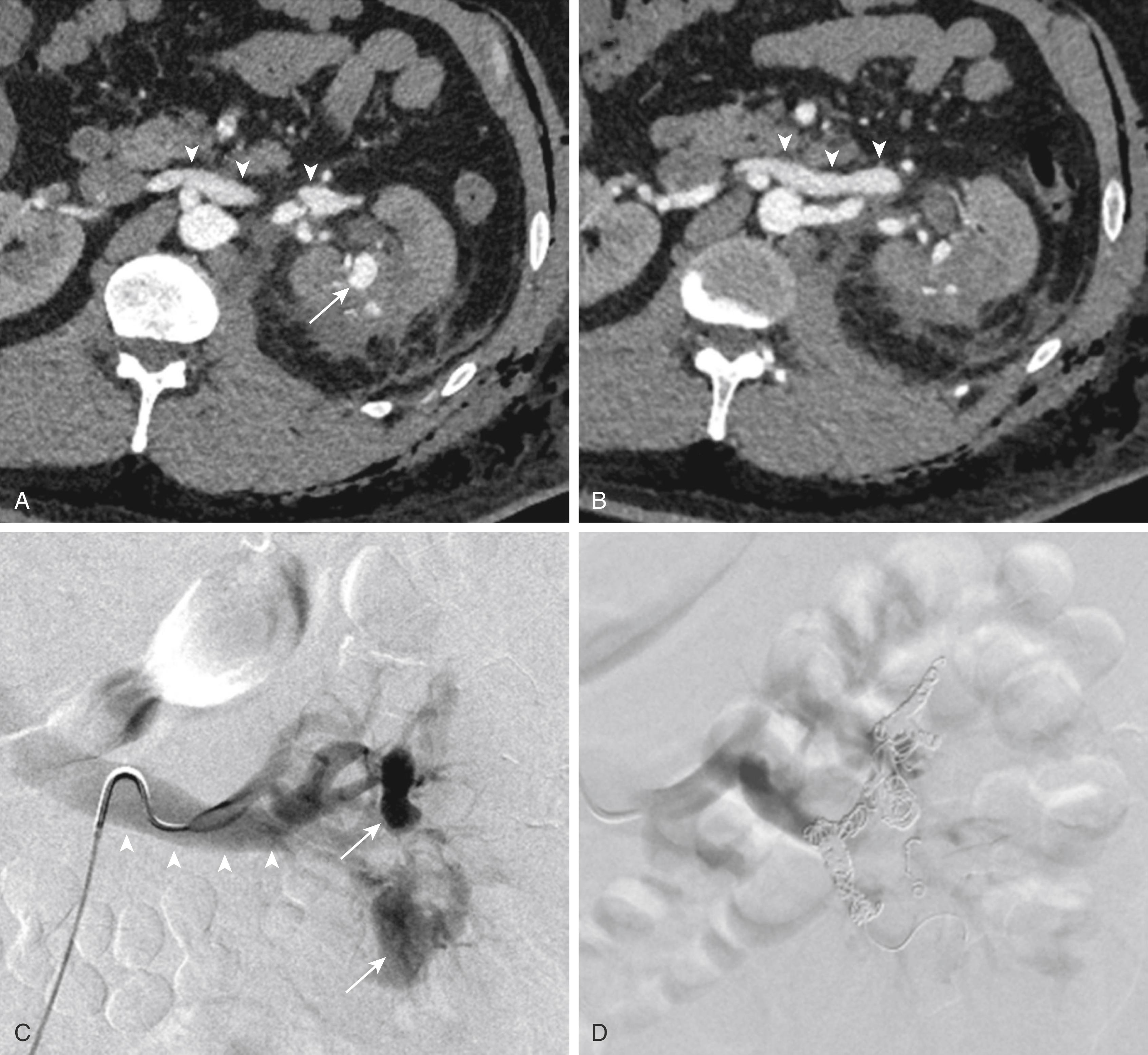 Figure 173.7, CT and angiogram of a patient with iatrogenic left renal pseudoaneurysms (PSAs) with an arteriovenous fistula (AVF) after partial nephrectomy. Axial arterial-phase CT images ( A, B ) at the level of kidneys show contrast collection in the left renal parenchyma ( arrow ), which simultaneously enhances with renal artery and the aorta, consistent with a PSA. In addition, there is early filling of the left renal vein ( arrowheads ), consistent with a renal AVF. Left perinephric stranding is due to early postoperative changes of partial nephrectomy. Left renal DSA image ( C ) shows PSAs along the middle and inferior segmental arteries ( arrows ) with an early draining vein in the arterial phase of the study ( arrowheads ), consistent a with renal AVF. DSA image of the left renal artery shows coil embolization of the middle and lower pole PSAs and segmental arteries with no opacification of the draining vein.