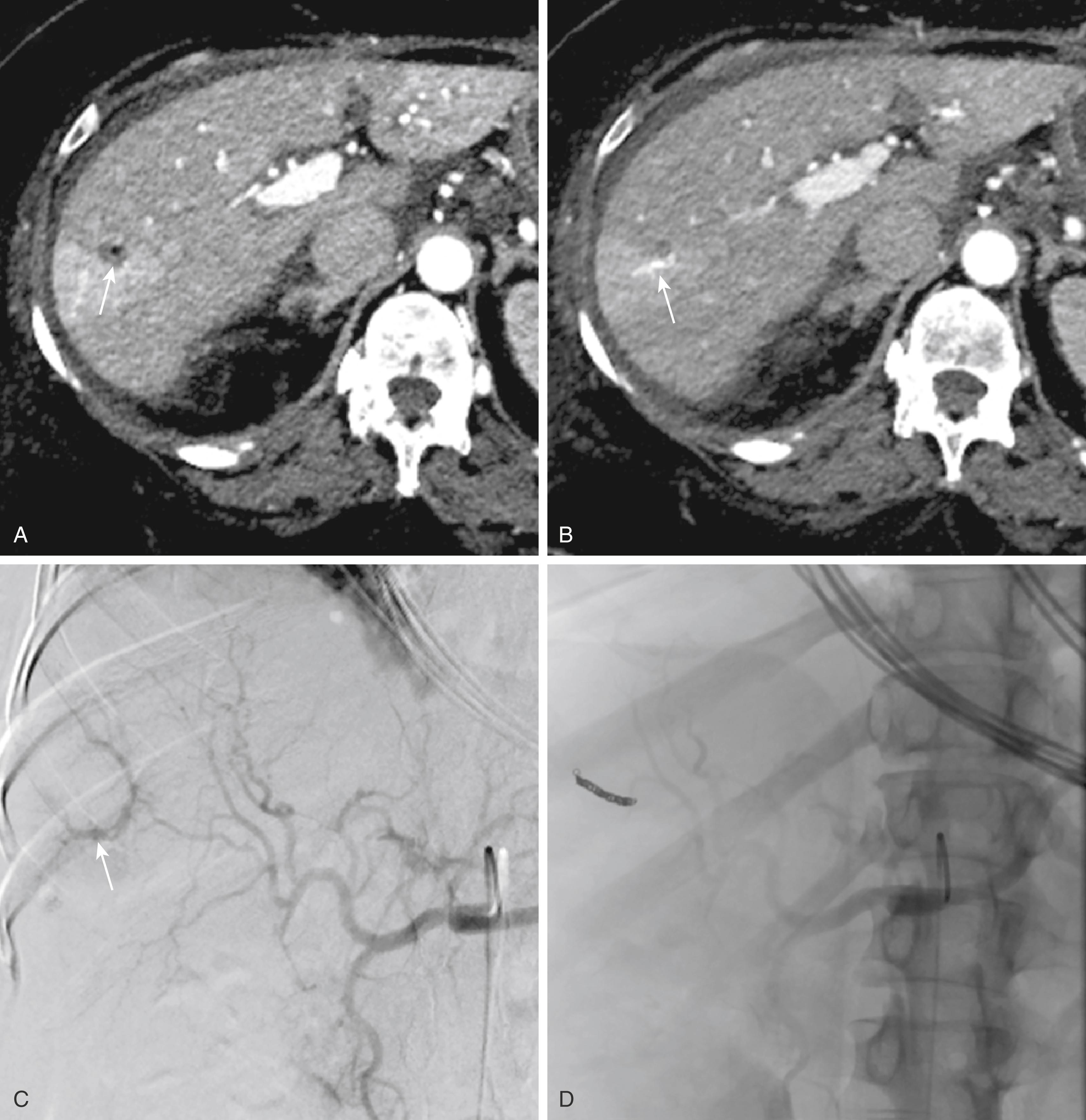 Figure 173.8, Axial CECT images of the abdomen shows changes of biopsy in segment VI ( arrow ) ( A ), with a prominent early filling of a small peripheral vein ( arrow ), suggesting an iatrogenic arterioportal fistula ( B ).Celiac artery digital subtraction angiogram (DSA) shows early filling of a peripheral portal vein ( arrow ), consistent with an arterioportal fistula ( C ). DSA image shows successful coil embolization of the hepatic arterioportal fistula with no early opacification of the portal venous branch ( D ).