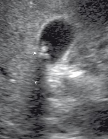 Figure 88.1, Cholelithiasis in a 17-year-old girl with abdominal pain.