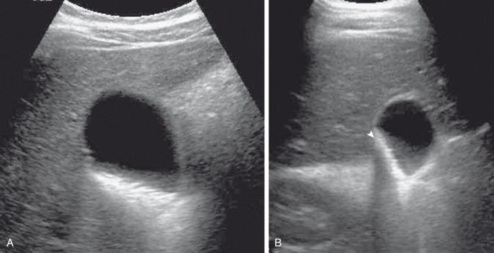 Figure 88.2, Cholelithiasis in a 16-year-old girl with right upper quadrant pain.