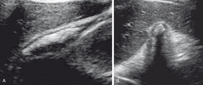 Figure 88.3, Cholelithiasis in a 16-year-old girl with abdominal pain.